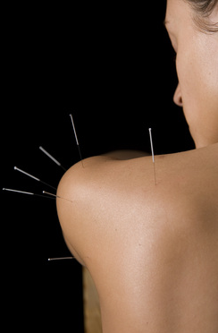 Traditional Chinese Acupuncture