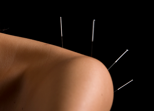 Why Choose Acupuncture?