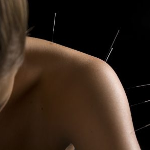 Acupuncture