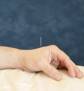 Acupuncture