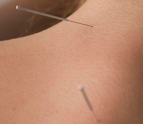 Acupuncture For Health