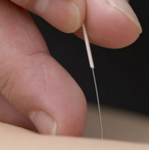 Acupuncture