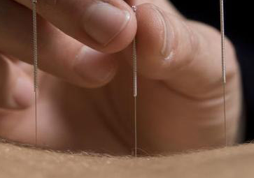 About Traditional Acupuncture