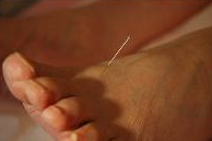 About Acupuncture