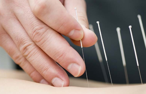 Acupuncture