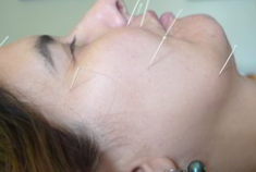 Facial Acupuncture