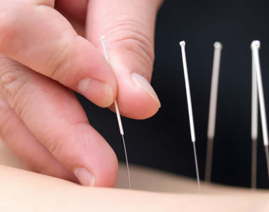 Acupuncture