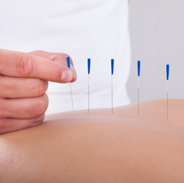 Introducing Acupuncture