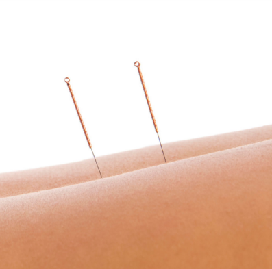 Medical Acupuncture or ‘Dry Needling’