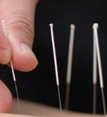 Acupuncture