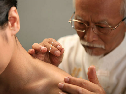 Acupuncture Treatment