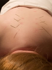 What is Acupuncture?