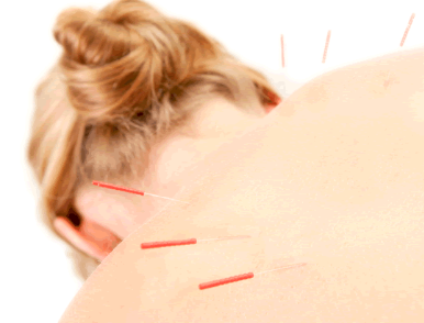 What is Acupuncture?