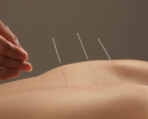 About Acupuncture Treatment