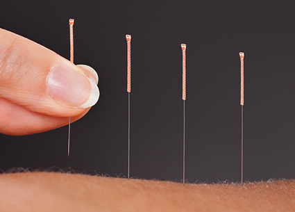 What is acupuncture?