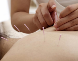 Acupuncture