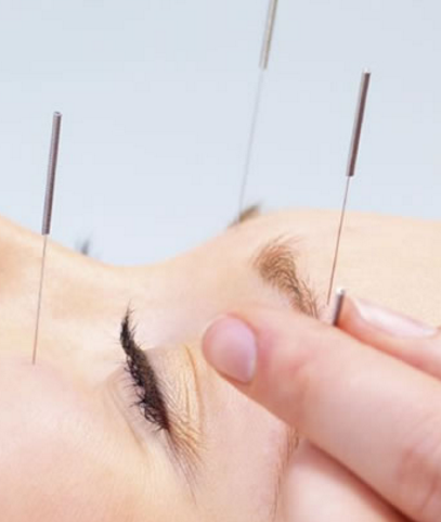 Acupuncture