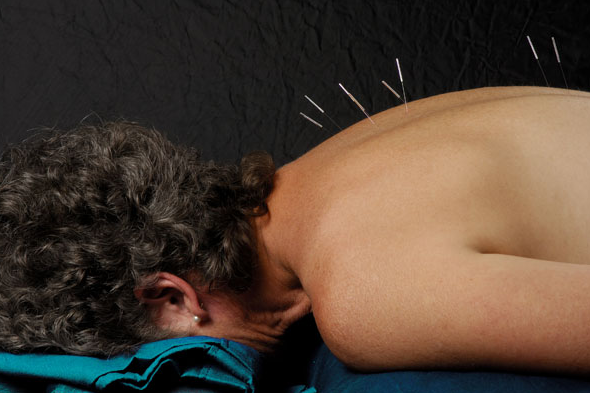 Acupuncture