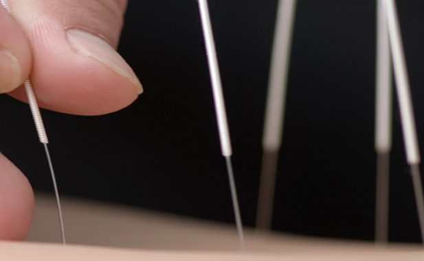 What is Acupuncture?