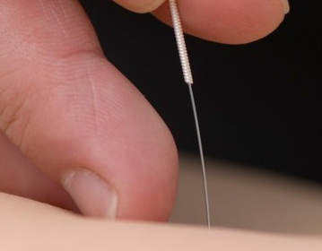 Acupuncture