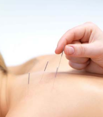 Acupuncture