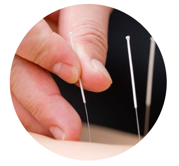 Acupuncture