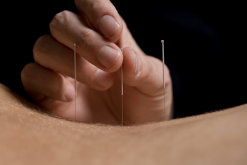 Acupuncture