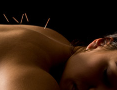 acupuncture