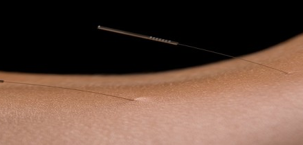 What does acupuncture do?