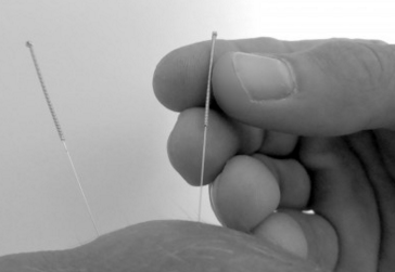 Origins of Acupuncture