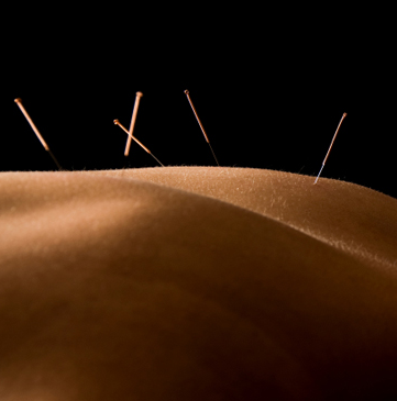 Acupuncture