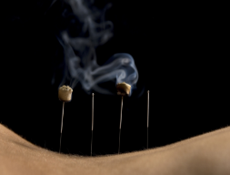 Acupuncture