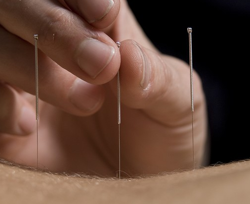 Acupuncture