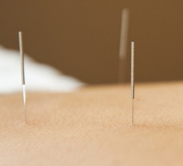 Syndrome Acupuncture