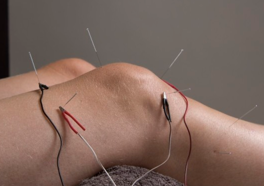 Acupuncture Services