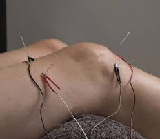 Electroacupuncture